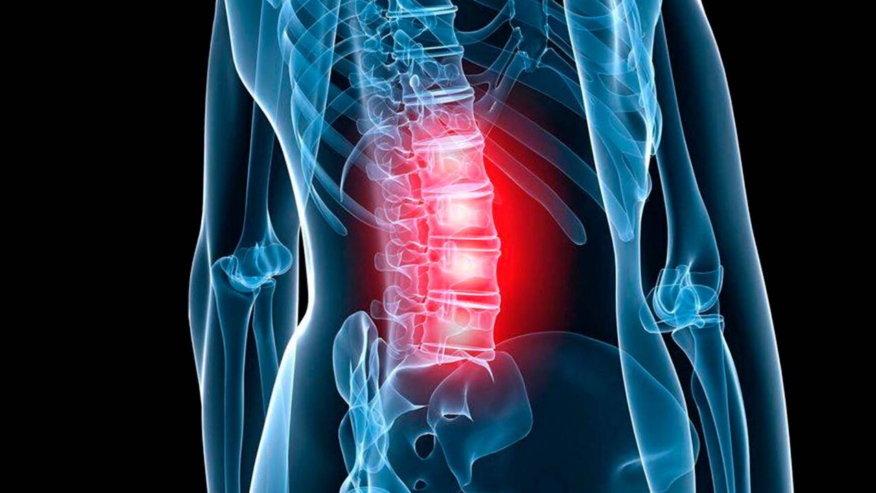 Symptoms of lumbar osteochondrosis