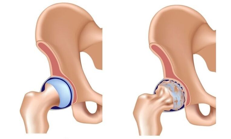 Healthy joints and joint joints