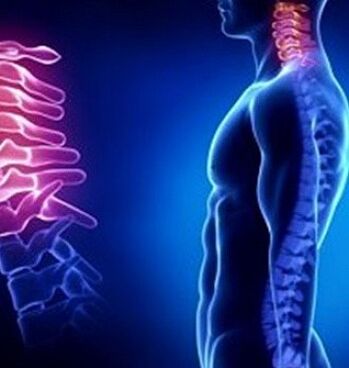 Cervical osteochondrosis can be caused by neck injury