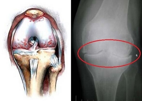 knee osteoarthritis